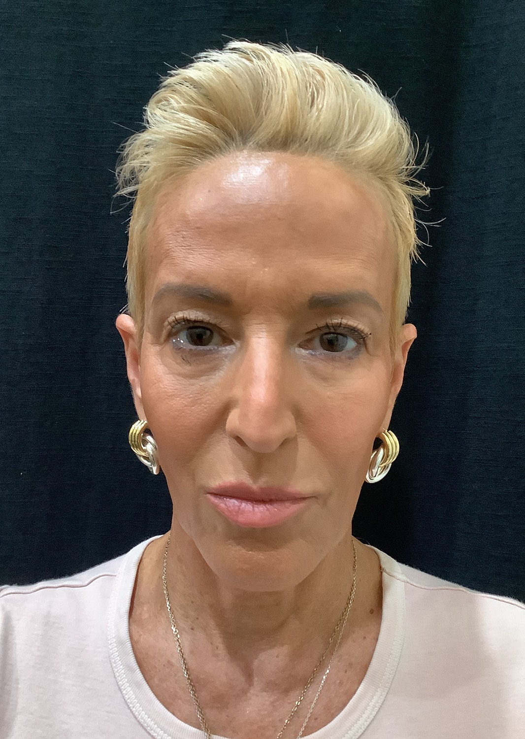 Eyelid Surgery Before & After