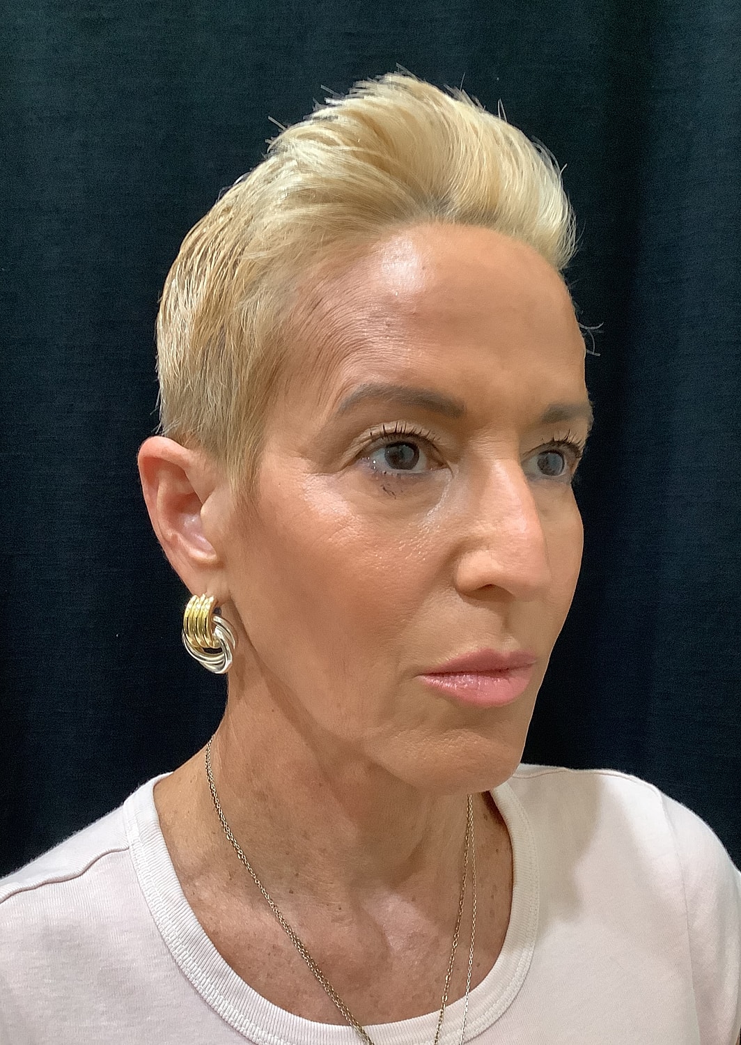 Eyelid Surgery Before & After
