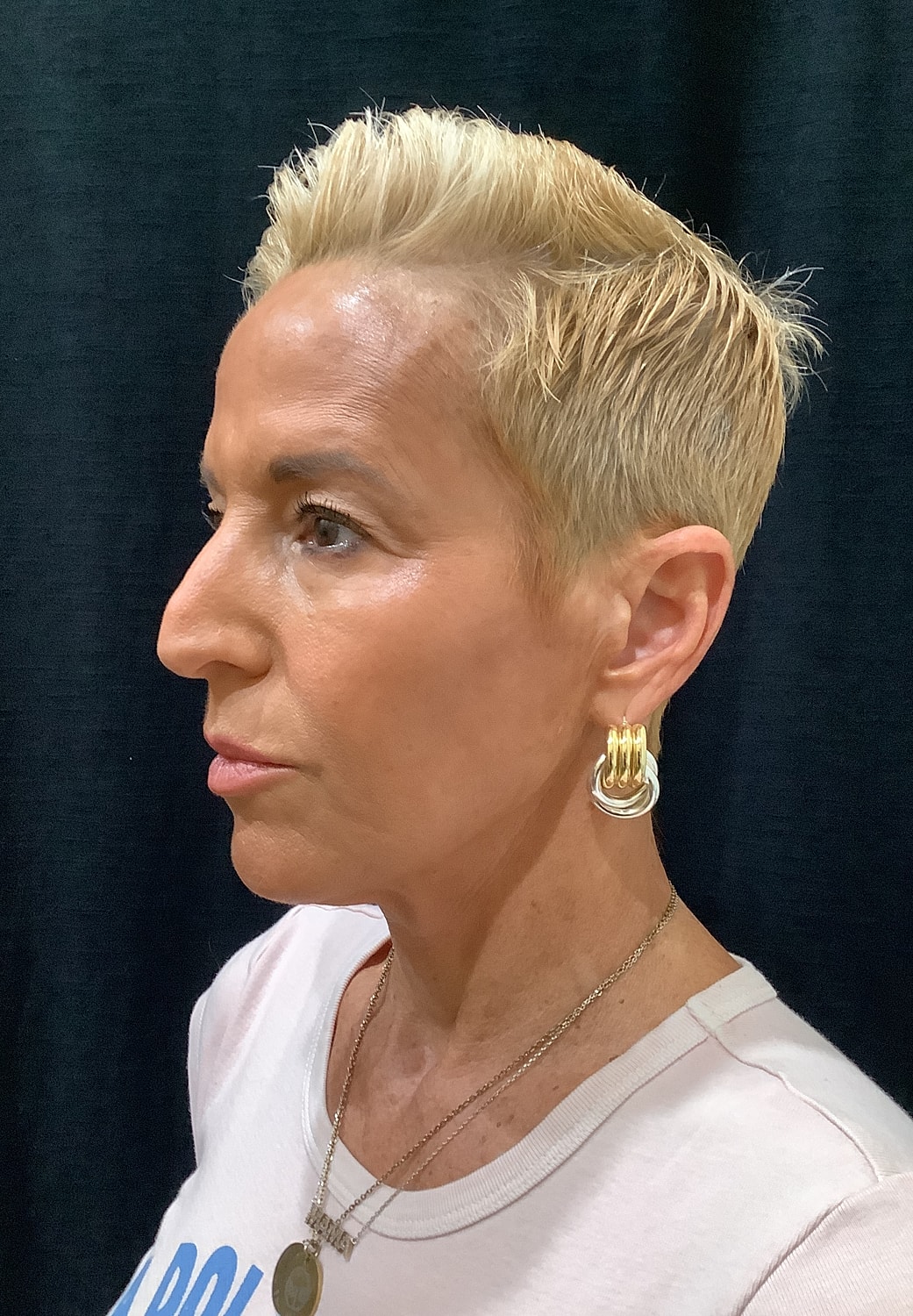 Eyelid Surgery Before & After