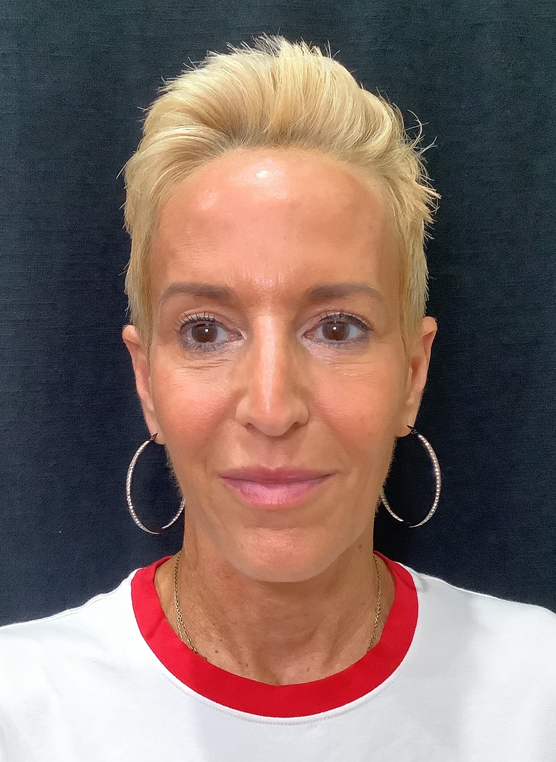Eyelid Surgery Before & After