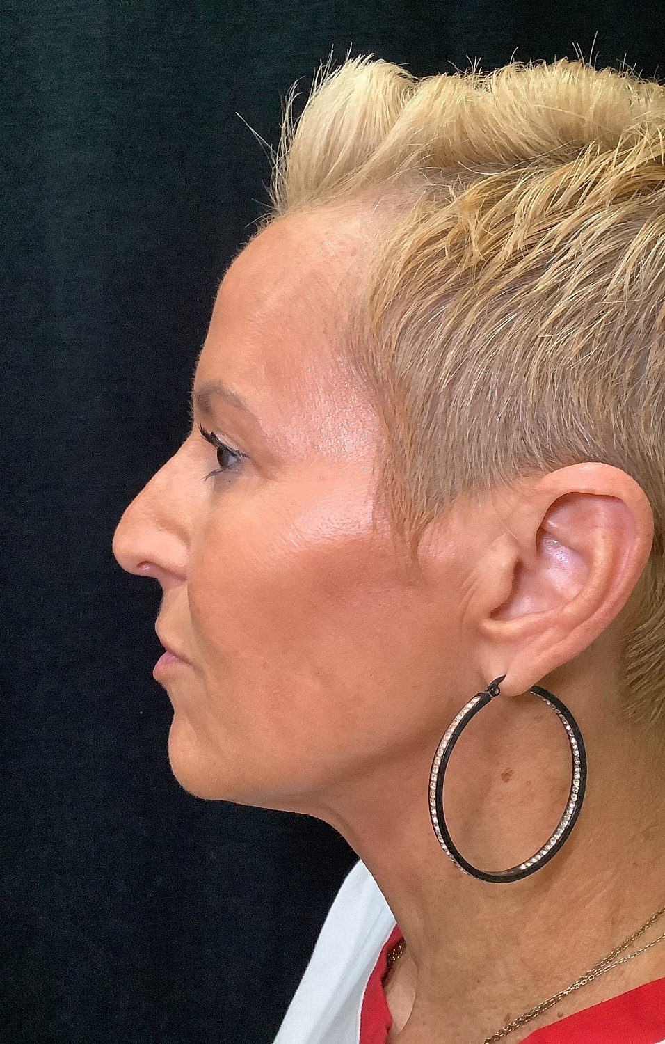 Eyelid Surgery Before & After