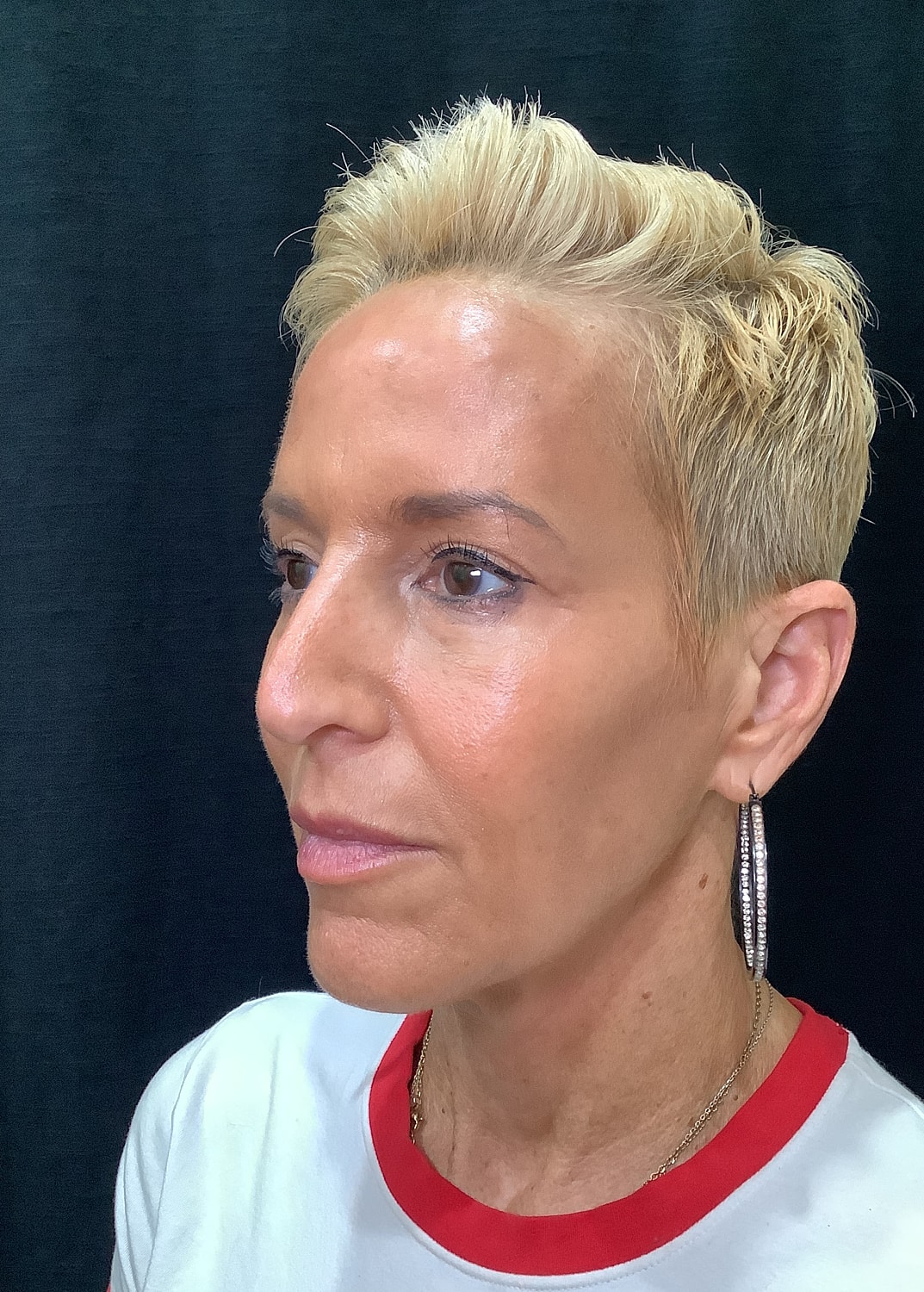 Eyelid Surgery Before & After