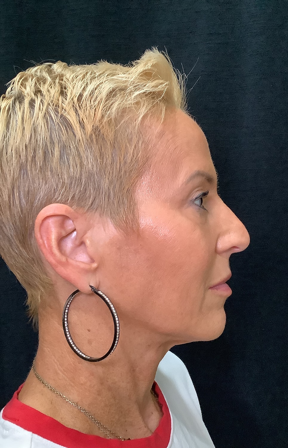 Eyelid Surgery Before & After