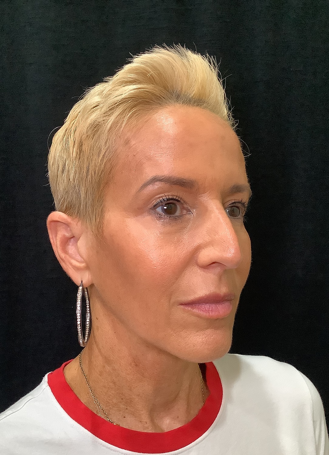 Eyelid Surgery Before & After