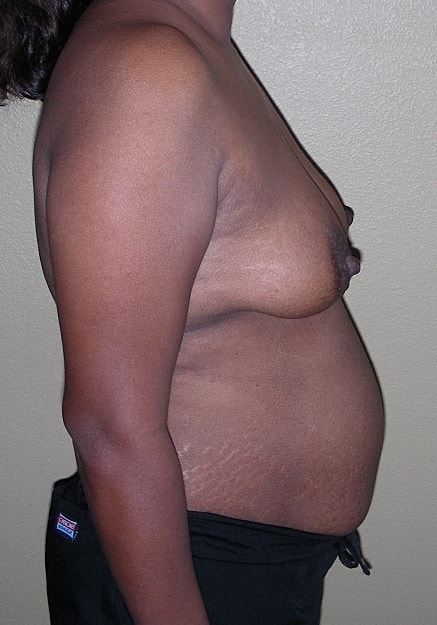 Mommy Makeover Before & After