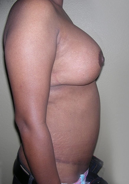 Mommy Makeover Before & After