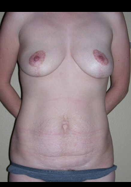 Mommy Makeover Before & After