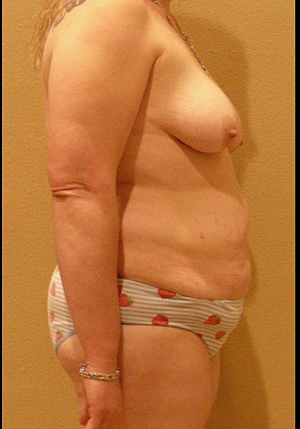 Mommy Makeover Before & After
