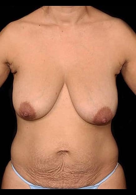 Mommy Makeover Before & After