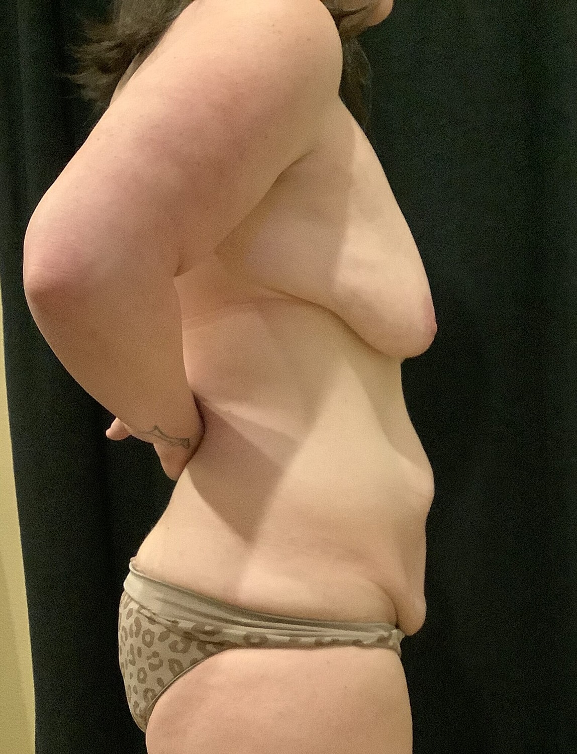 Mommy Makeover Before & After