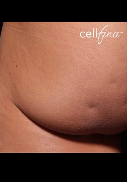 Cellfina Before & After