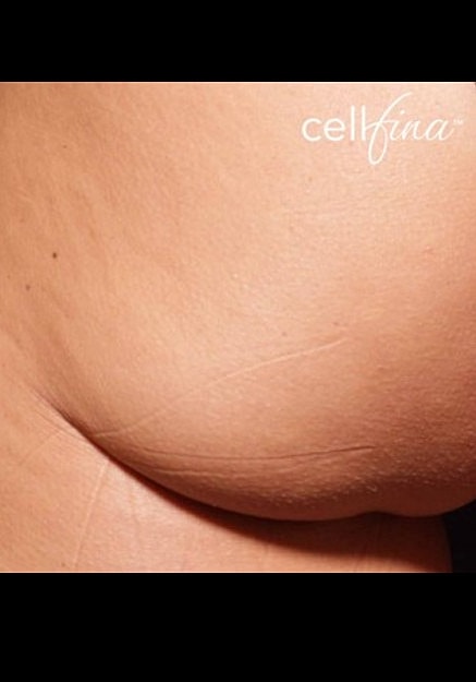 Cellfina Before & After
