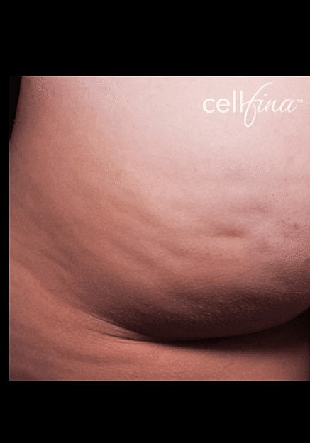Cellfina Before & After
