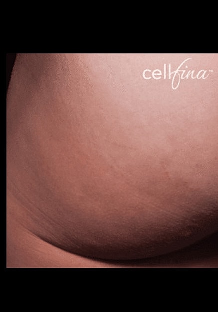 Cellfina Before & After