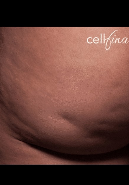 Cellfina Before & After