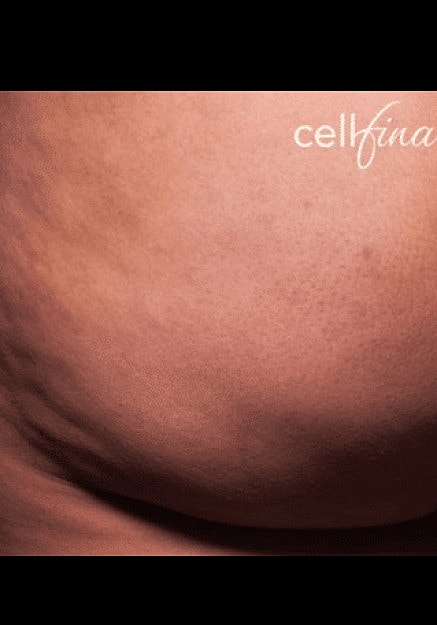 Cellfina Before & After