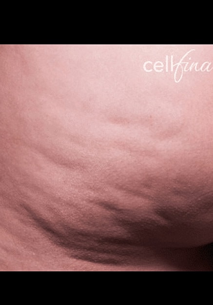 Cellfina Before & After
