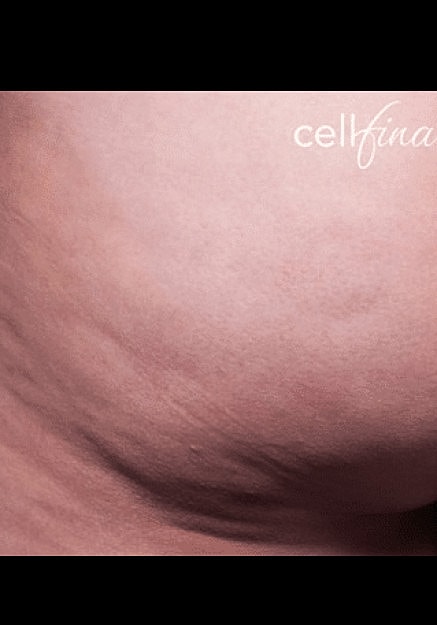 Cellfina Before & After