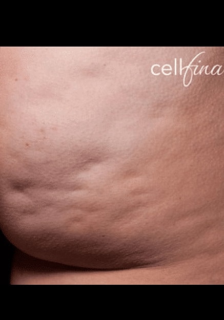 Cellfina Before & After