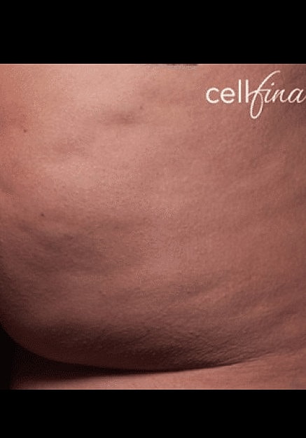 Cellfina Before & After