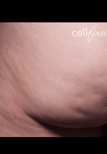 Cellfina Before & After