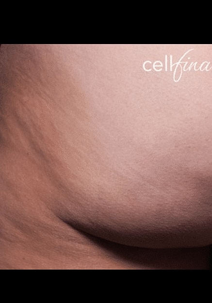 Cellfina Before & After