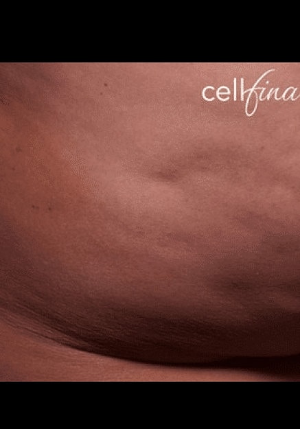 Cellfina Before & After