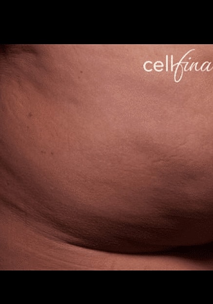 Cellfina Before & After