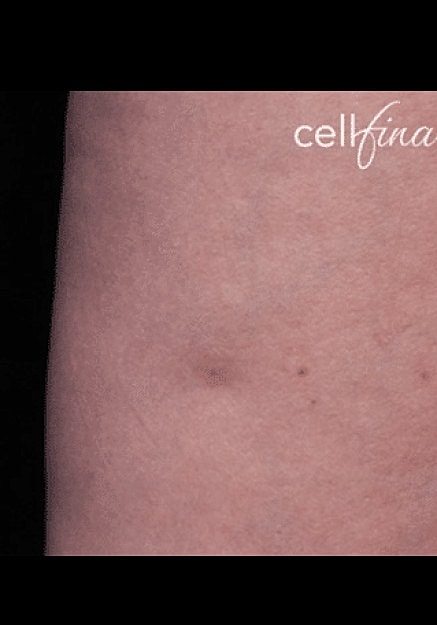 Cellfina Before & After