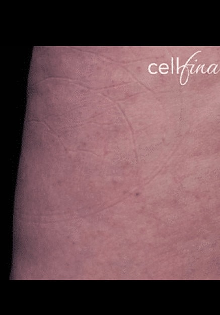 Cellfina Before & After