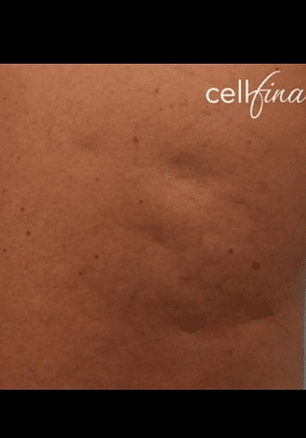 Cellfina Before & After