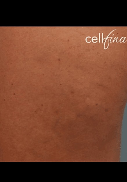 Cellfina Before & After
