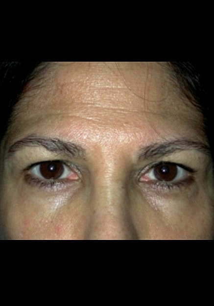 Browlift Before & After