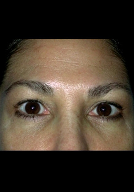Browlift Before & After