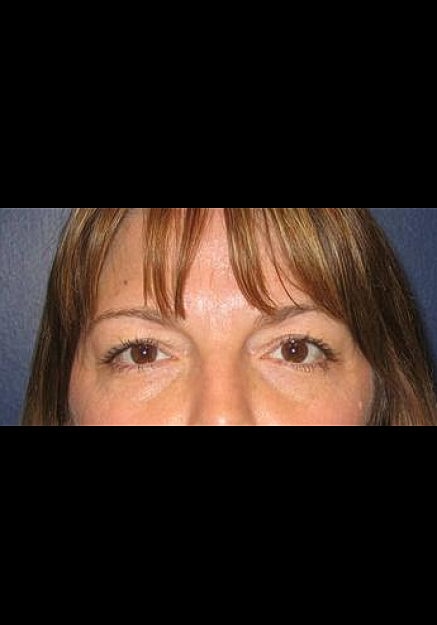 Browlift Before & After