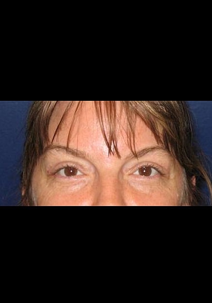 Browlift Before & After