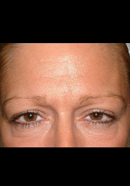 Browlift Before & After