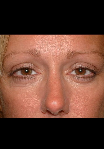 Browlift Before & After