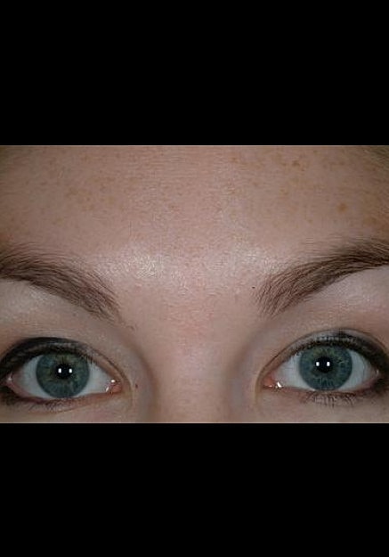Browlift Before & After
