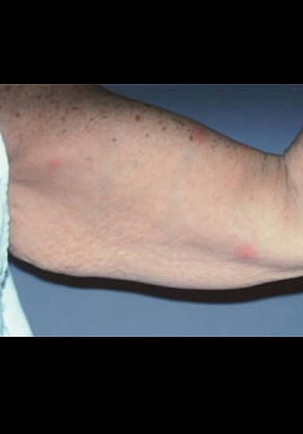 Arm Lift Before & After