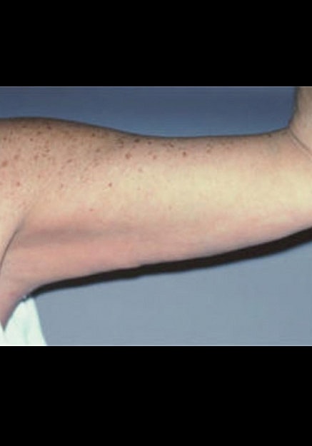 Arm Lift Before & After
