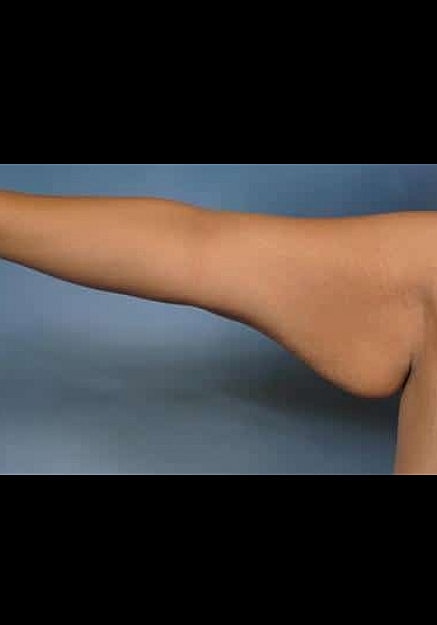 Arm Lift Before & After