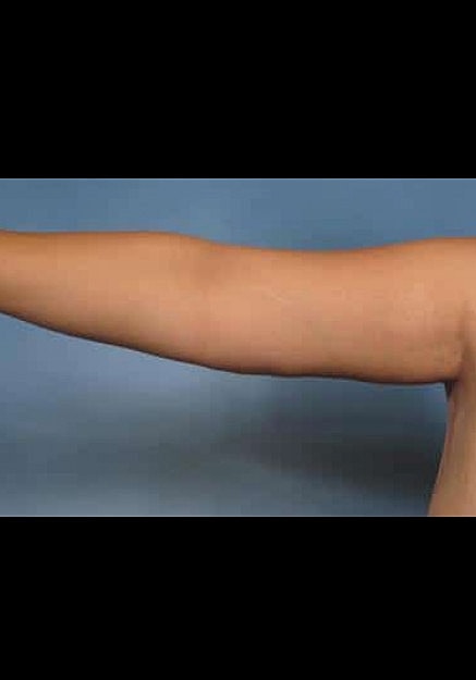 Arm Lift Before & After