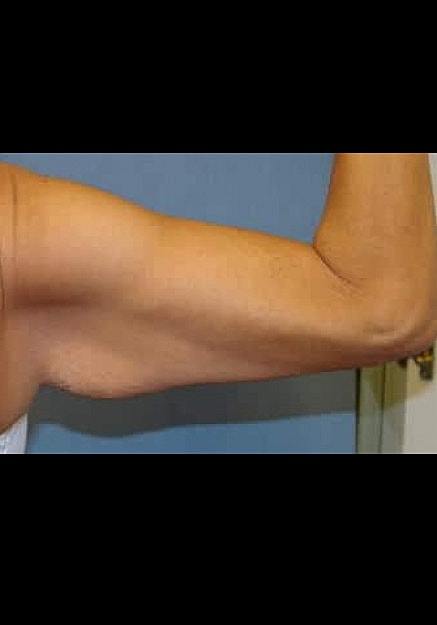 Arm Lift Before & After