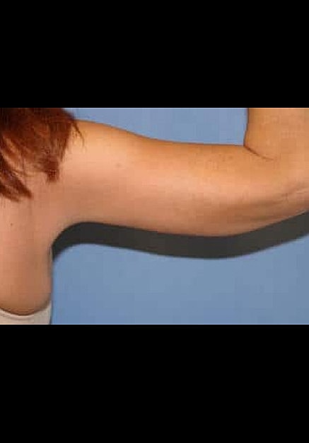 Arm Lift Before & After