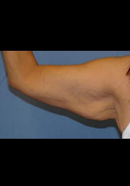 Arm Lift Before & After