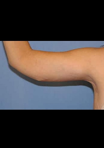 Arm Lift Before & After