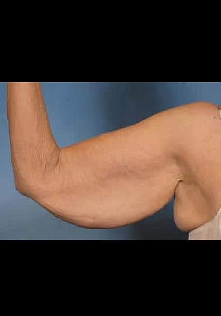 Arm Lift Before & After