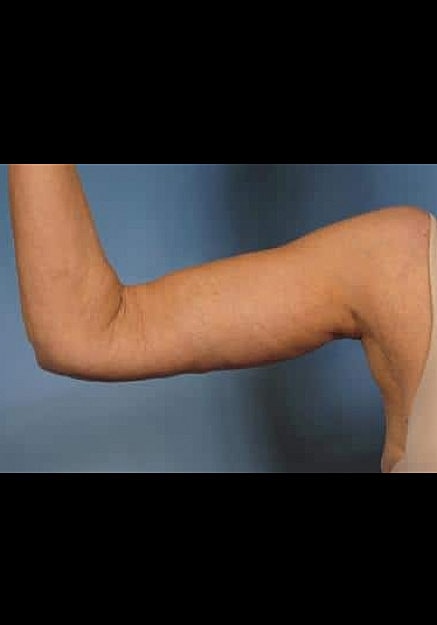 Arm Lift Before & After