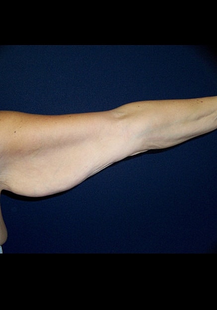 Arm Lift Before & After
